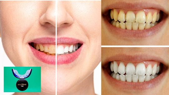 primal life organics teeth whitening system reviews